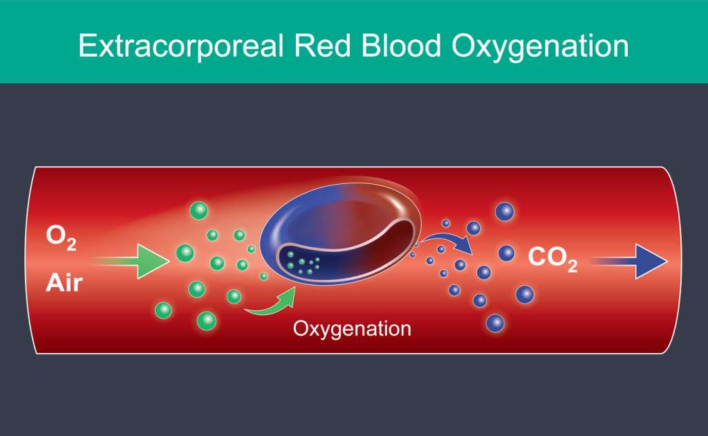 Extracorporeal Blood Oxygenation Ozonization Atlantic Highlands NJ